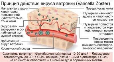 Опасна ли ветрянка при беременности?